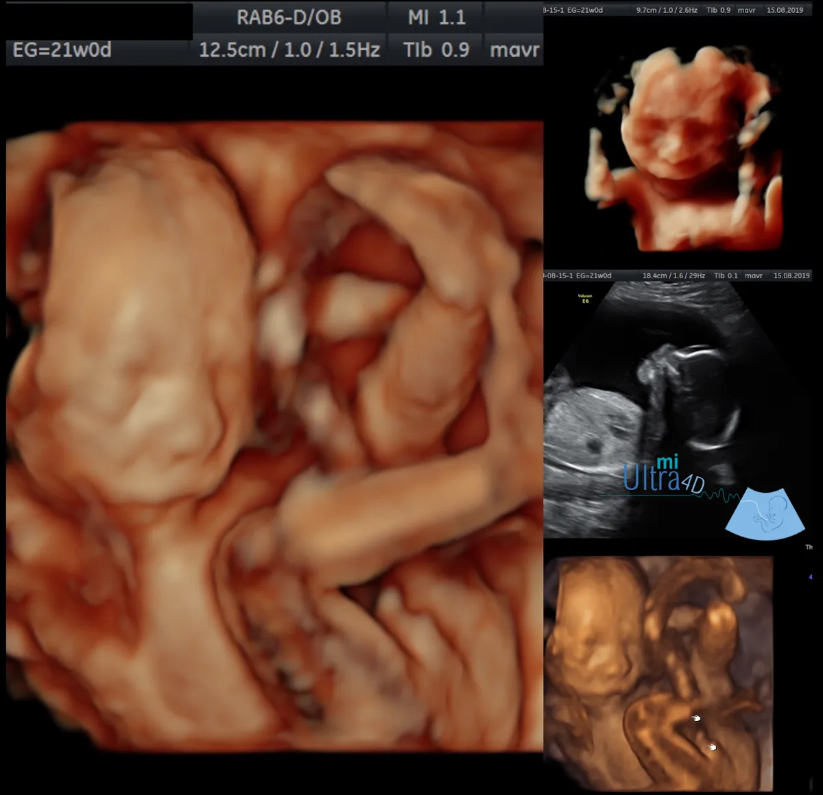 Foto 3 de 4D/5D miUltra4D, por GINECOLOGO & ULTRASONIDO 4D/5D (miUltra4D)